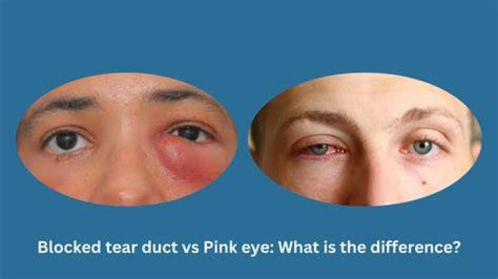 Is pink eye a big deal?