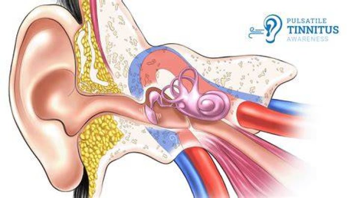 Is pulsatile tinnitus an emergency?