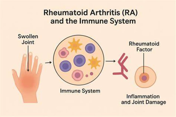 Is RA an autoimmune disease?