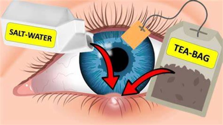 Is salt water good for a stye?