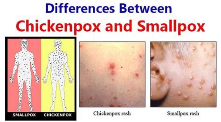 Is smallpox and chickenpox the same thing?