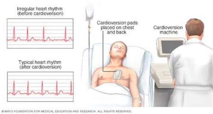Is the patient awake during cardioversion?
