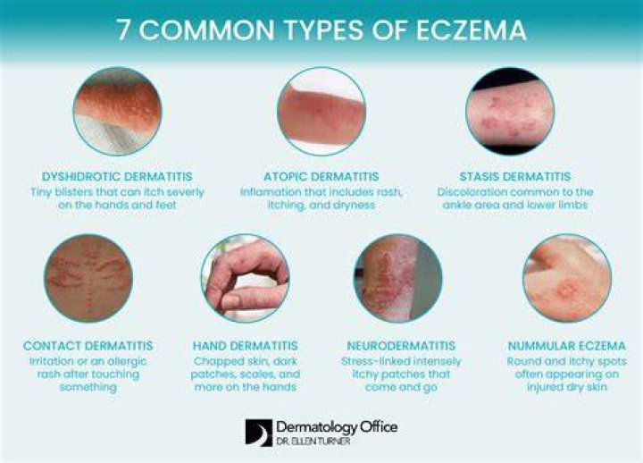 Is there a shot for eczema?