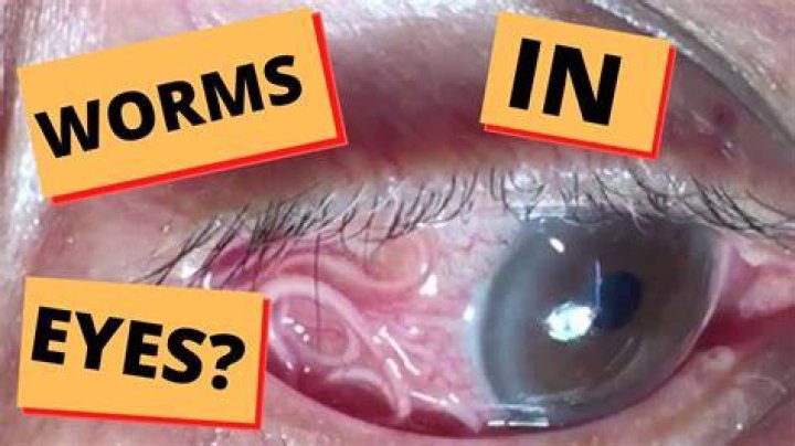 Is there a worm in my eye?