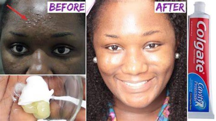 Is toothpaste good for dark spots?