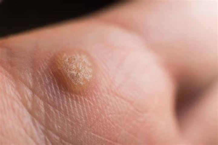 Is touching a wart contagious?