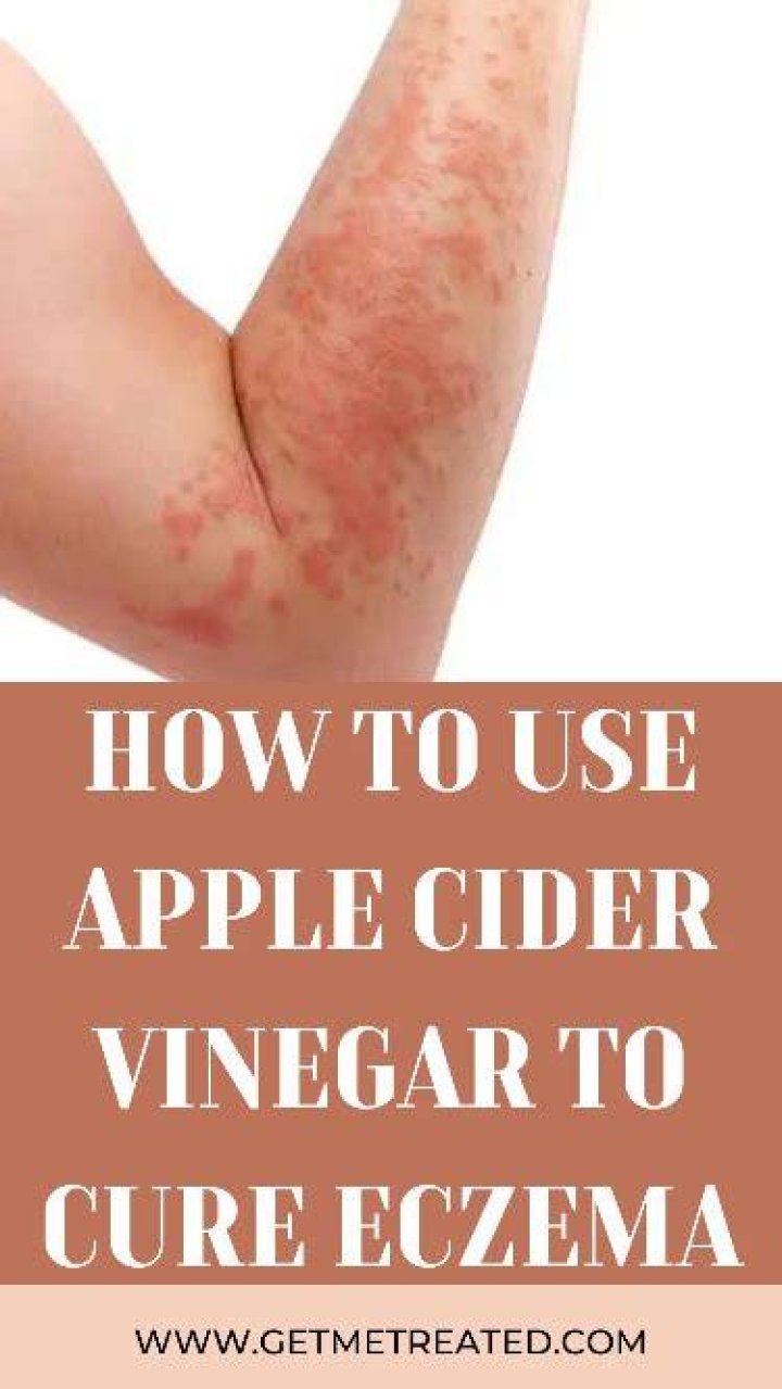 Is vinegar good for eczema?