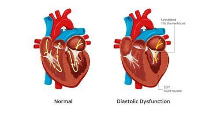Is walking good for diastolic dysfunction?