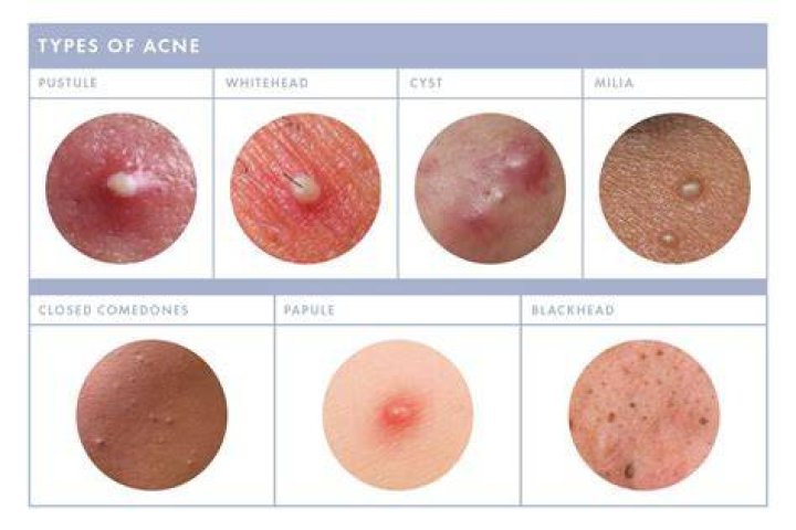 Should you pop a pimple if it has a white head?