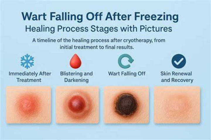 Should you put a bandaid on a wart after freezing?