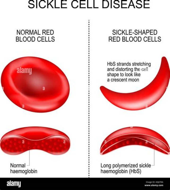 Was sickle cell created?