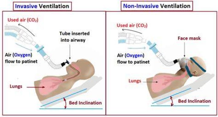 What's the difference between a ventilator and intubation?