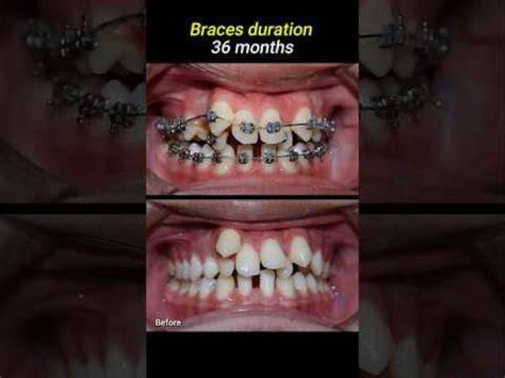 What's the longest for braces?