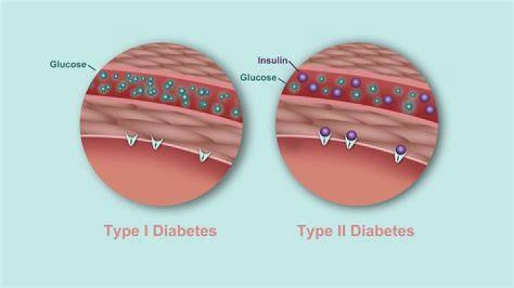 What's worse type 1 or type 2 diabetes?