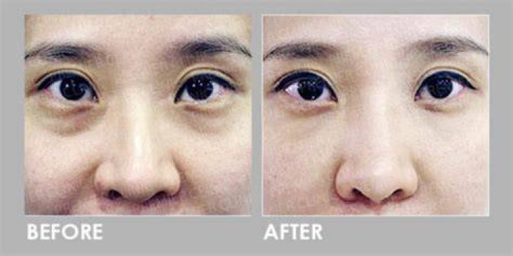 What are panda eyes caused from?