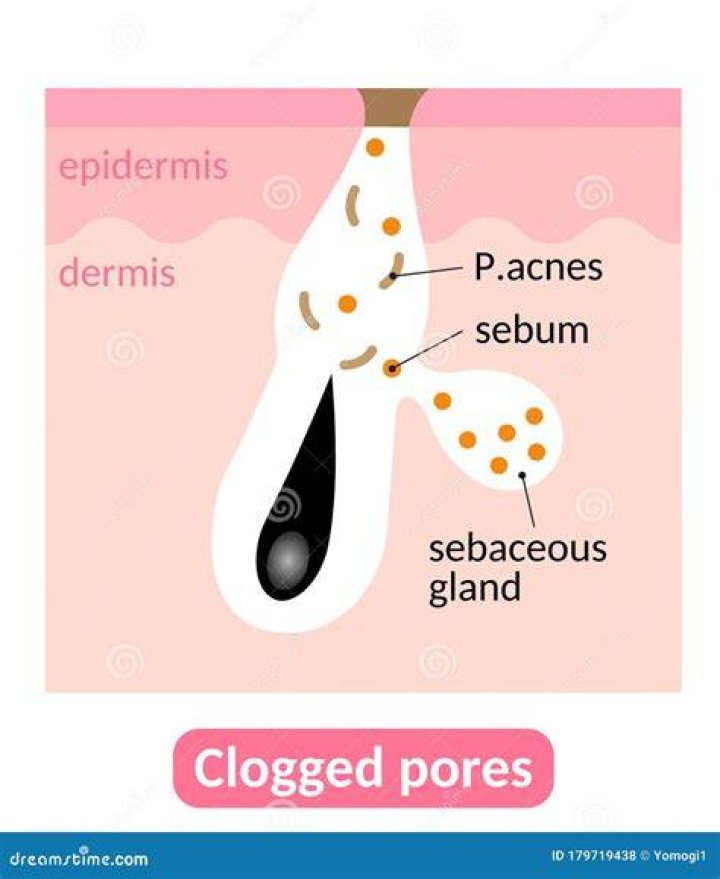What are plugs of sebum that block pores?