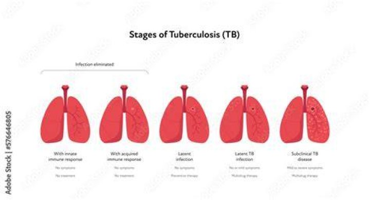 What are the 3 stages of TB?