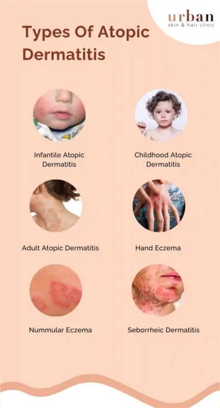 What are the 3 types of dermatitis?