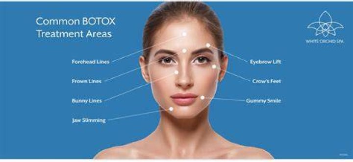 What are the 4 areas of Botox?
