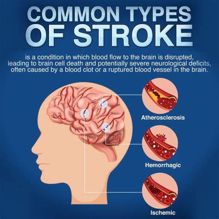 What are the 4 causes of a stroke?