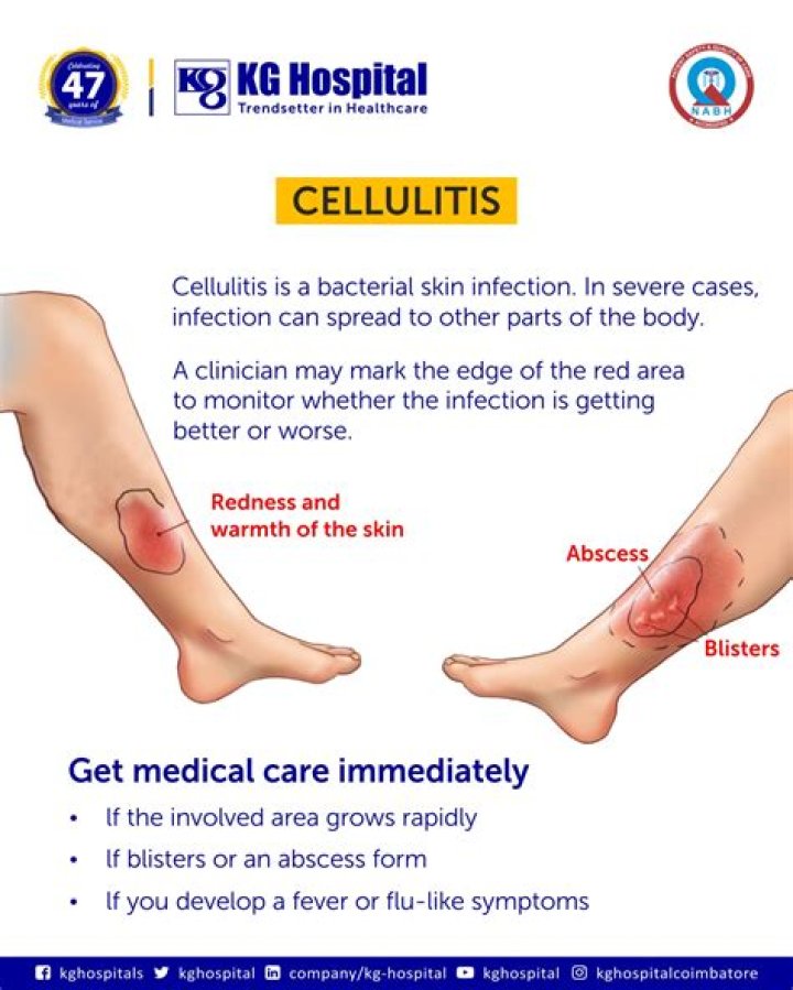 What are the symptoms of cellulitis gets into the bloodstream?