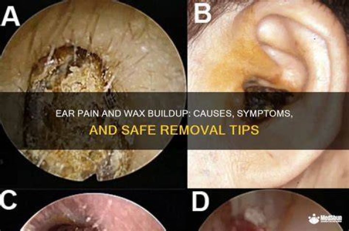 What are the symptoms of ear wax build up?