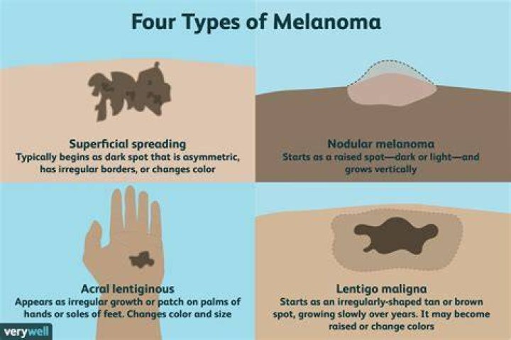 What are the symptoms of melanoma that has spread?