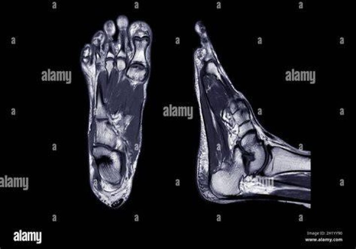 What can an MRI show for foot pain?