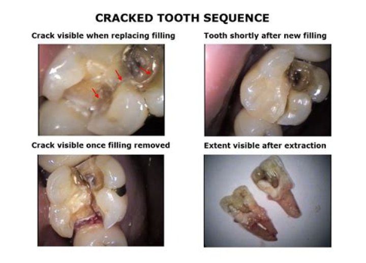 What can be done for a cracked tooth?