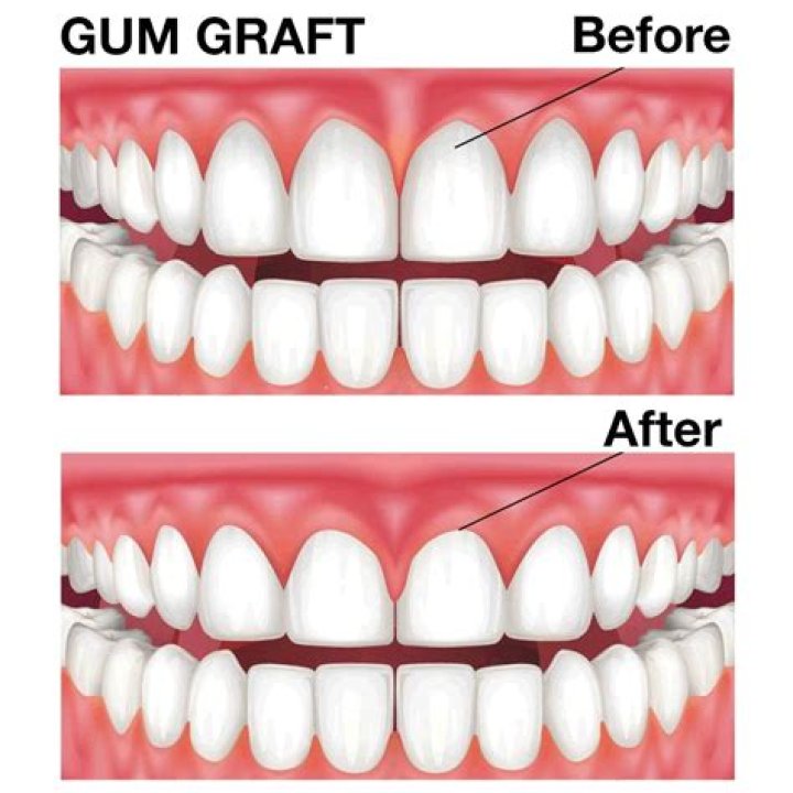What can you not do after a gum graft?