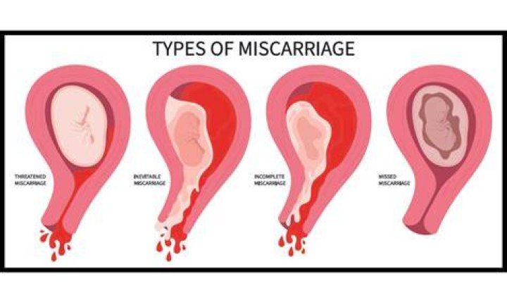 What caused Claire's miscarriage?