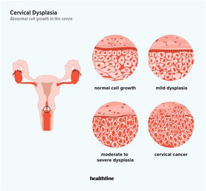 What causes cervical dysplasia besides HPV?