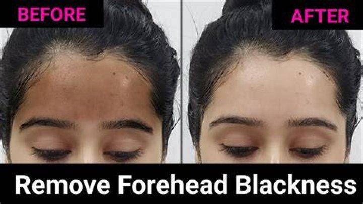 What causes dark forehead?