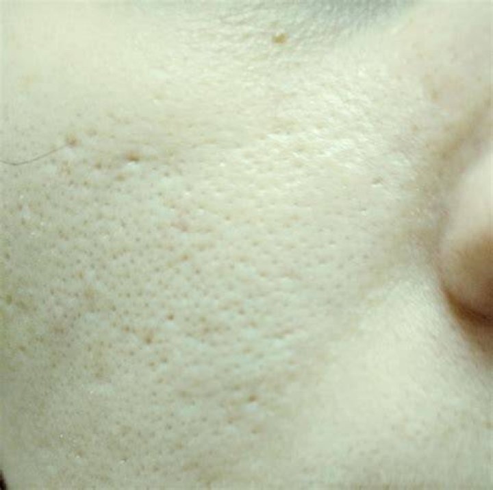 What causes holes in your face?