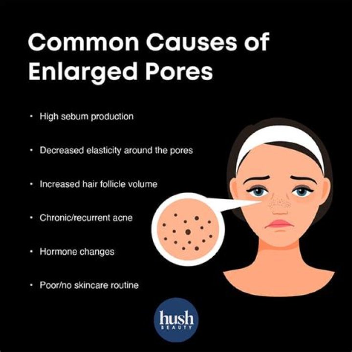 What causes large pores?