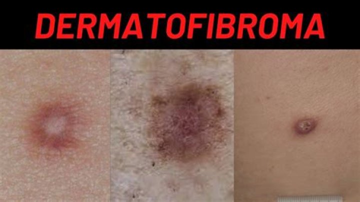 What causes multiple dermatofibroma?