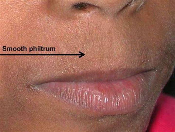 What causes no philtrum?