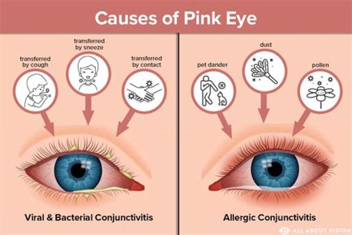 What causes pink eye?