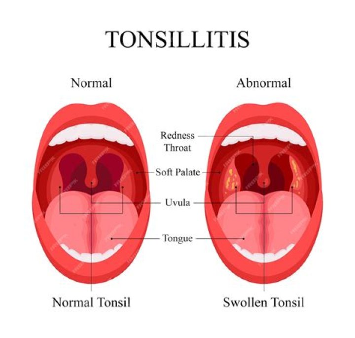 What causes tonsils?
