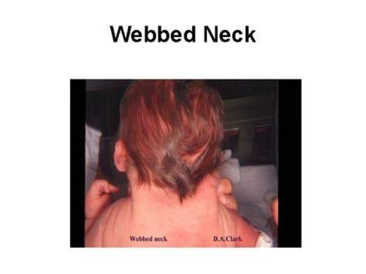 What causes webbed neck?