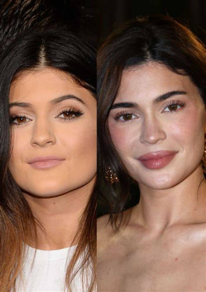 What celebrities get lip fillers?