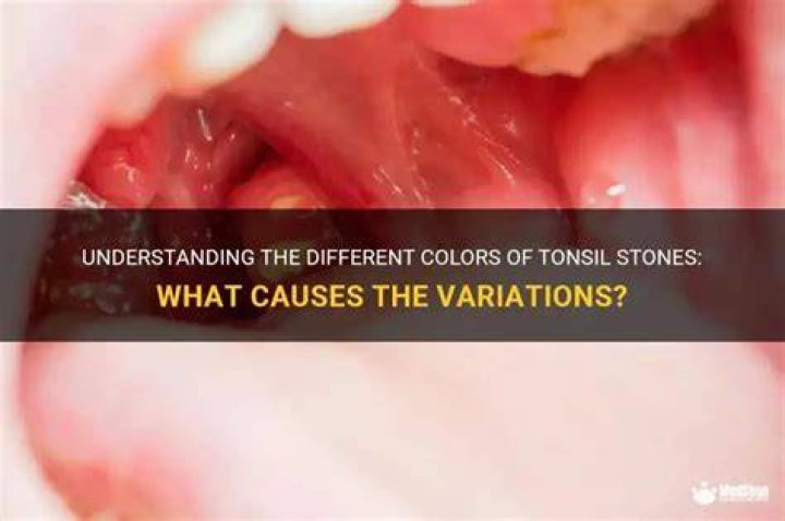 What color should tonsil stones be?