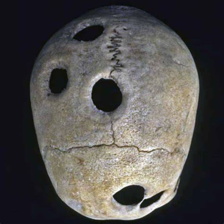 What did trepanation treat?