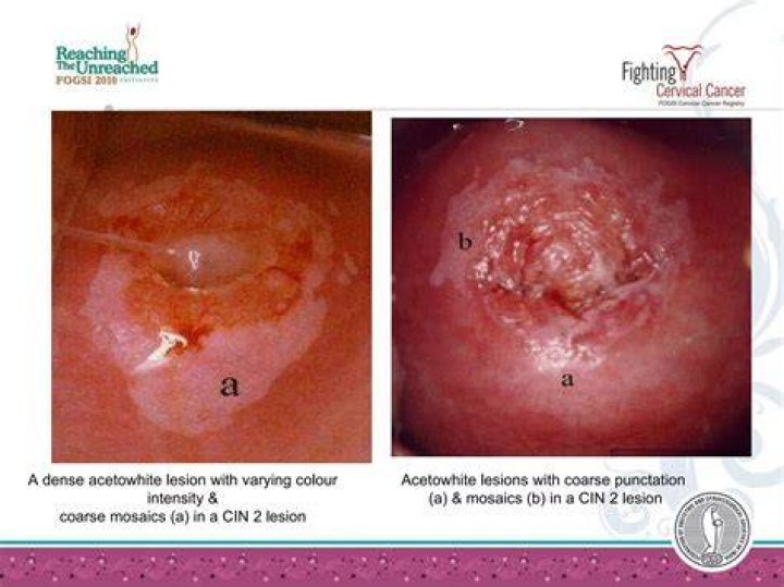What do colposcopy results show?