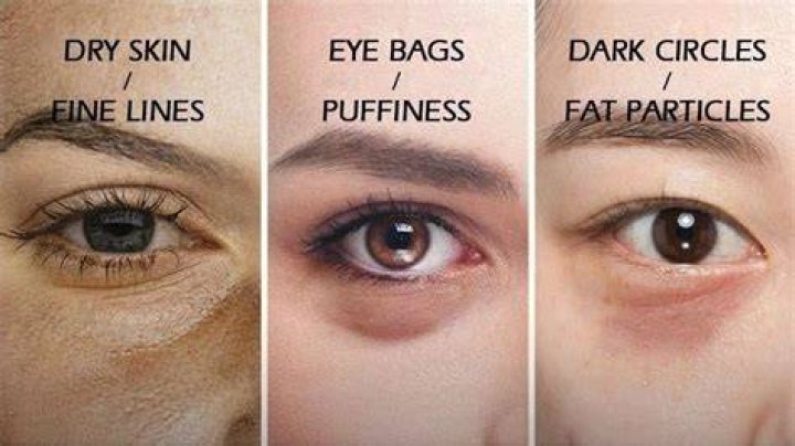 What do eye bags indicate?
