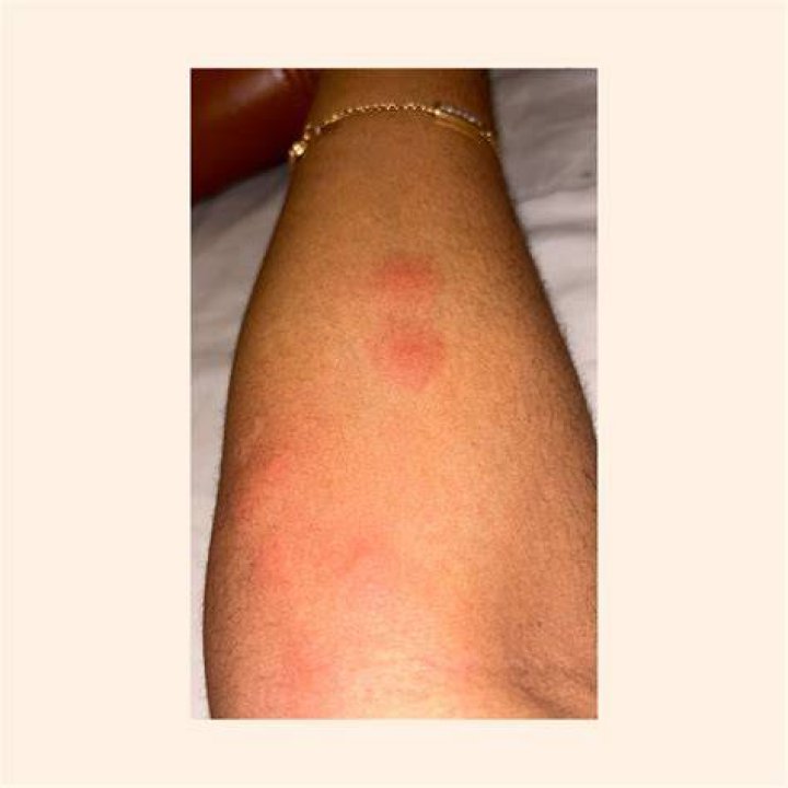 What do love bites look like?