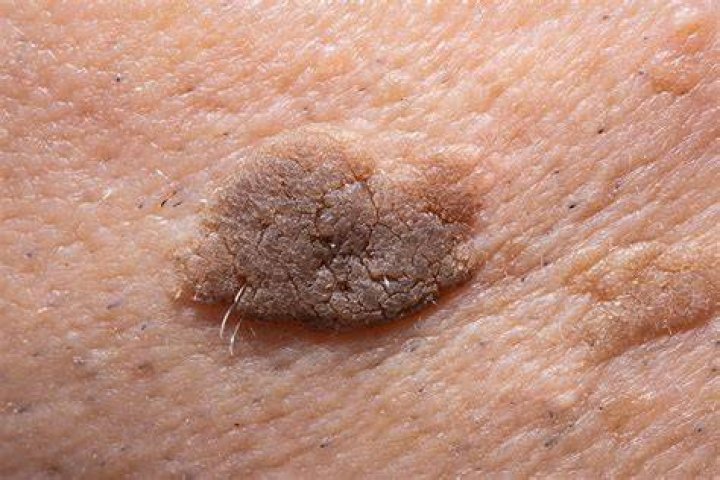 What do Seborrhoeic keratosis look like?