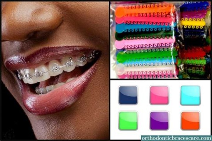 What do the colors on braces do?
