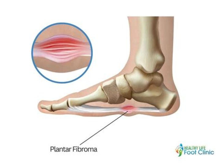 What doctor treats plantar fibroma?