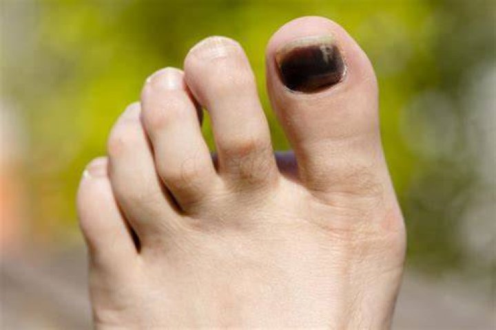 What does a black toenail mean?